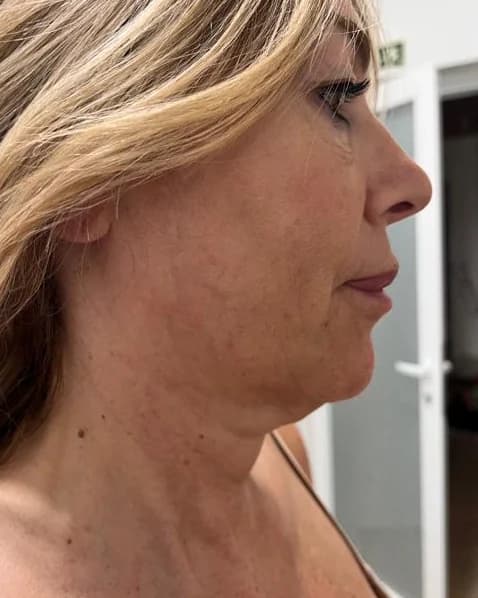 Perfil do maxilar e do pescoço, antes do tratamento